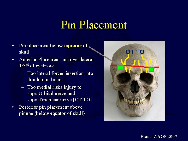 Pin Placement • Pin placement below equator of skull • Anterior Placement just over