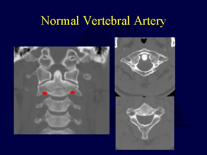 Normal Vertebral Artery 