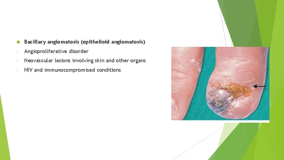 Bartonella henselae Bacillary angiomatosis (epithelioid angiomatosis) - Angioproliferative disorder - Neovascular lesions involving skin