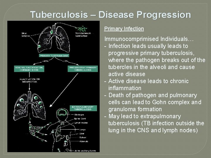 Tuberculosis – Disease Progression Primary Infection Immunocomprimised Individuals… - Infection leads usually leads to