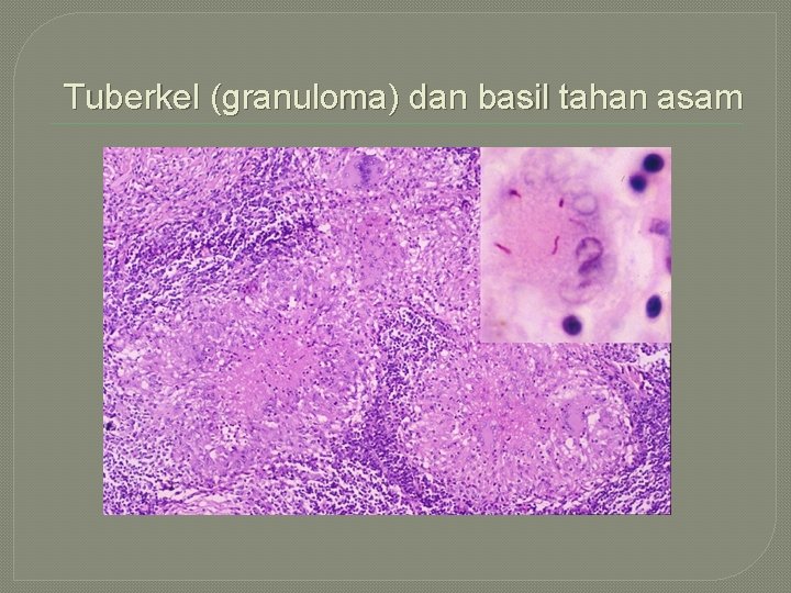 Tuberkel (granuloma) dan basil tahan asam 