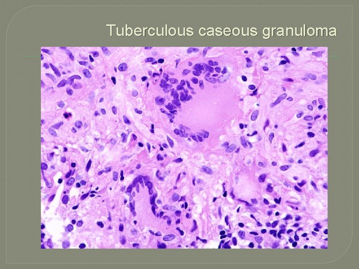 Tuberculous caseous granuloma 