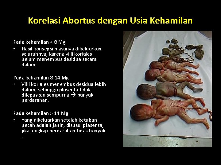 Korelasi Abortus dengan Usia Kehamilan Pada kehamilan < 8 Mg • Hasil konsepsi biasanya