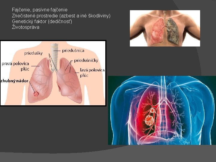 Fajčenie, pasívne fajčenie Znečistené prostredie (azbest a iné škodliviny) Genetický faktor (dedičnosť) Životospráva 