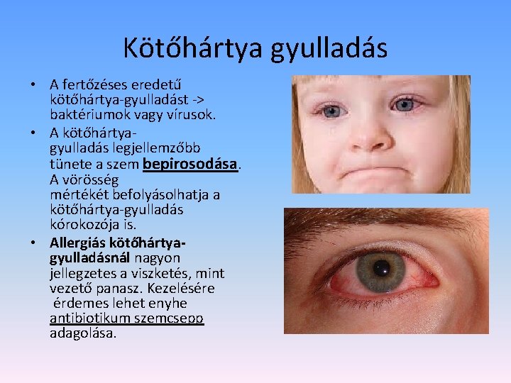 Kötőhártya gyulladás • A fertőzéses eredetű kötőhártya-gyulladást -> baktériumok vagy vírusok. • A kötőhártyagyulladás