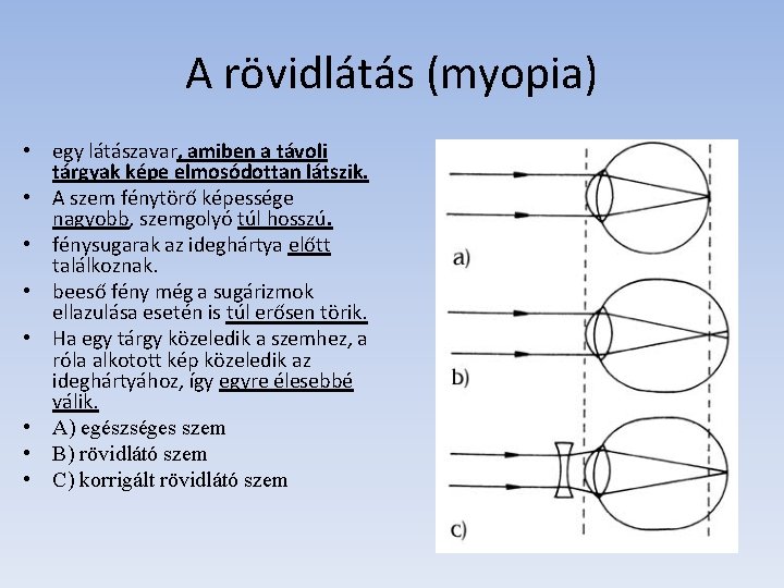 A rövidlátás (myopia) • egy látászavar, amiben a távoli tárgyak képe elmosódottan látszik. •