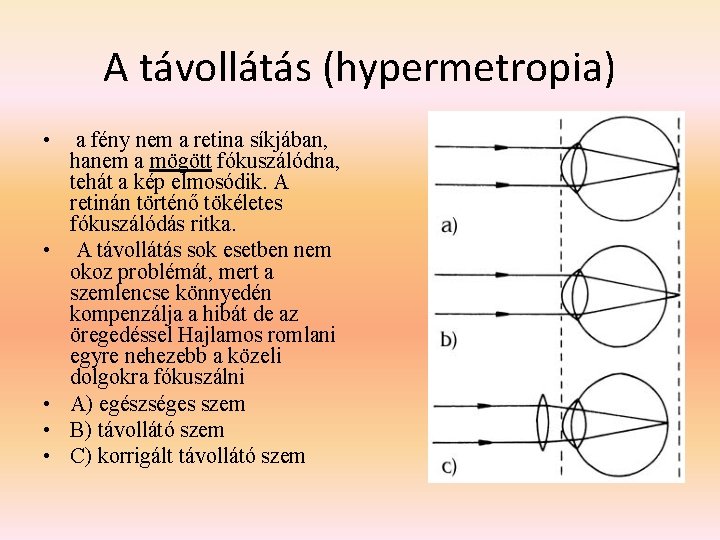 A távollátás (hypermetropia) • a fény nem a retina síkjában, hanem a mögött fókuszálódna,