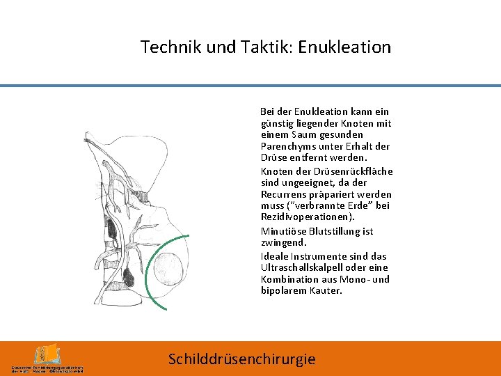 Technik und Taktik: Enukleation Bei der Enukleation kann ein günstig liegender Knoten mit einem