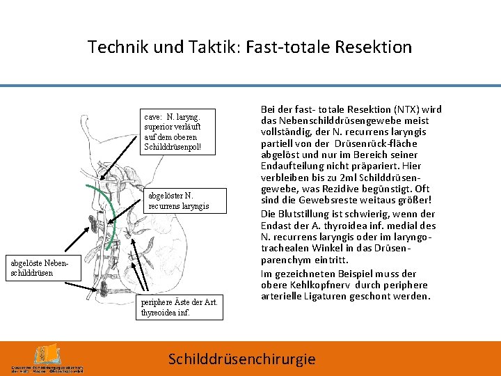 Technik und Taktik: Fast-totale Resektion cave: N. laryng. superior verläuft auf dem oberen Schilddrüsenpol!