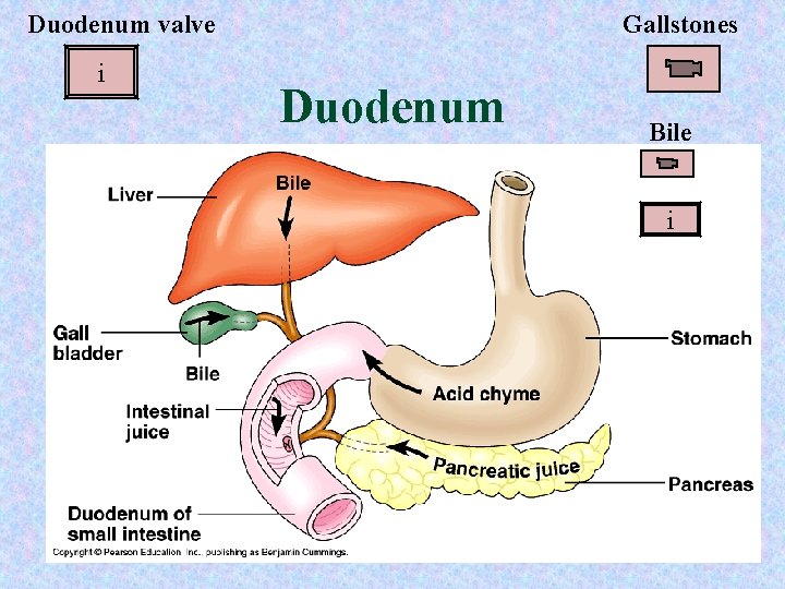 Duodenum valve i Gallstones Duodenum Bile i 