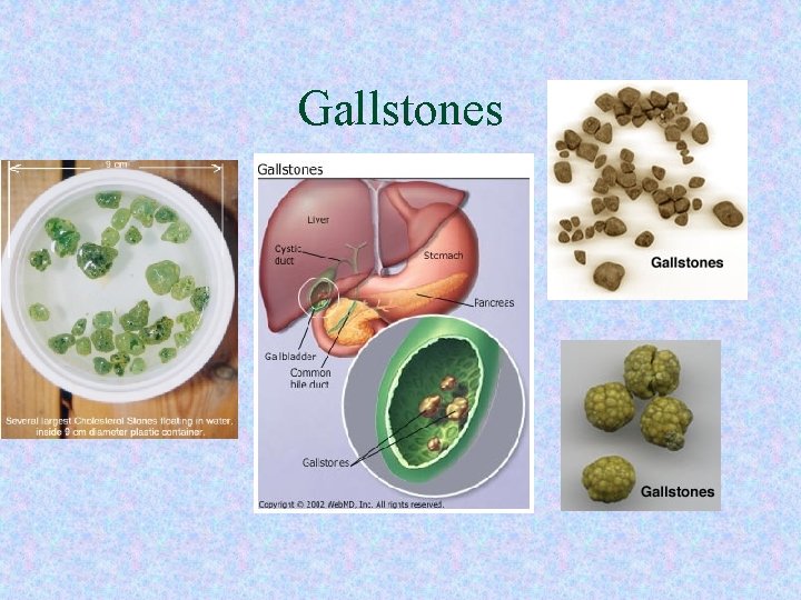 Gallstones 