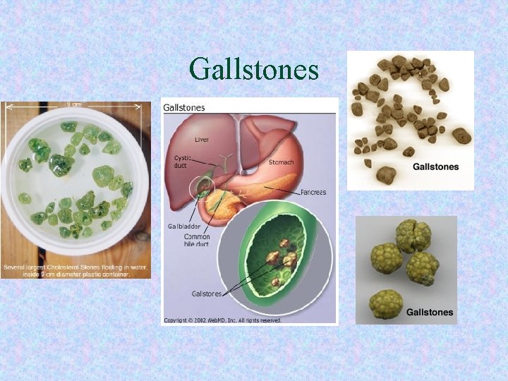 Gallstones Gallstones