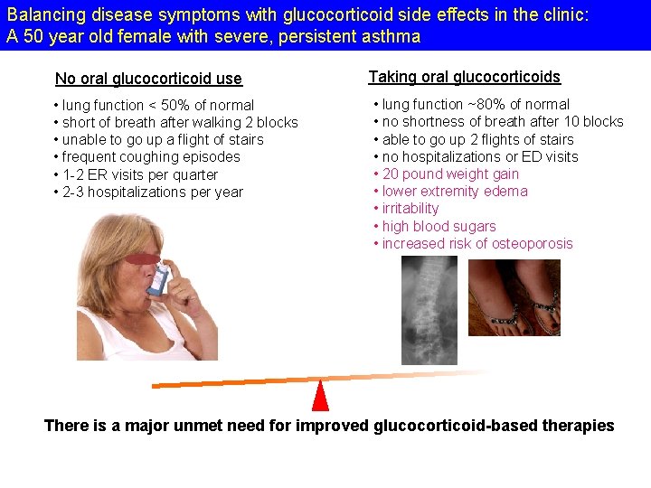 Balancing disease symptoms with glucocorticoid side effects in the clinic: A 50 year old