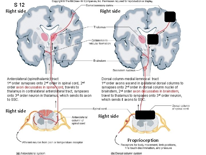 S 12 Right side Anterolateral (spinothalamic) tract 1 st order synapses onto 2 nd