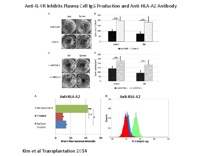 Anti-IL-6 R Inhibits Plasma Cell Ig. G Production and Anti-HLA-A 2 Antibody Anti-HLA-A 2