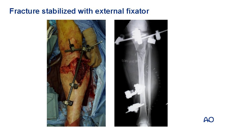 Fracture stabilized with external fixator 