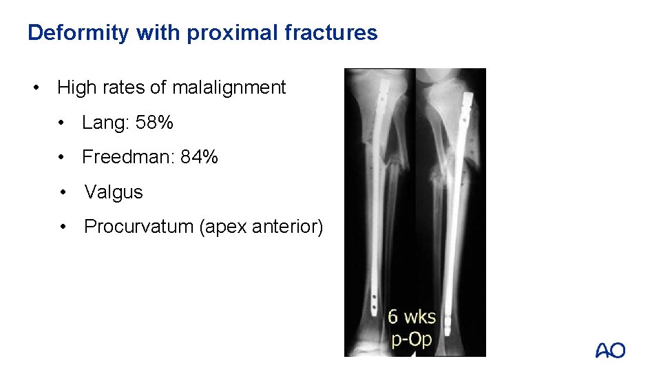 Deformity with proximal fractures • High rates of malalignment • Lang: 58% • Freedman: