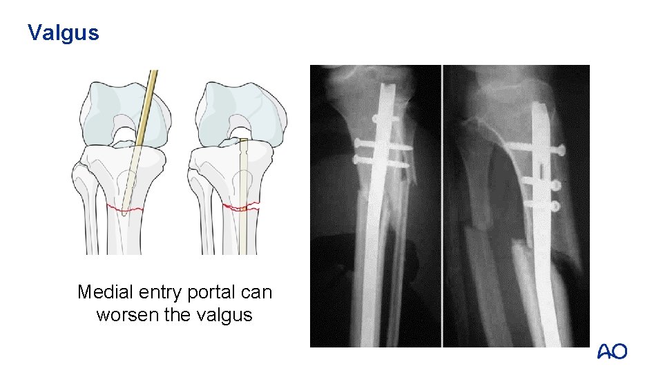 Valgus Medial entry portal can worsen the valgus 