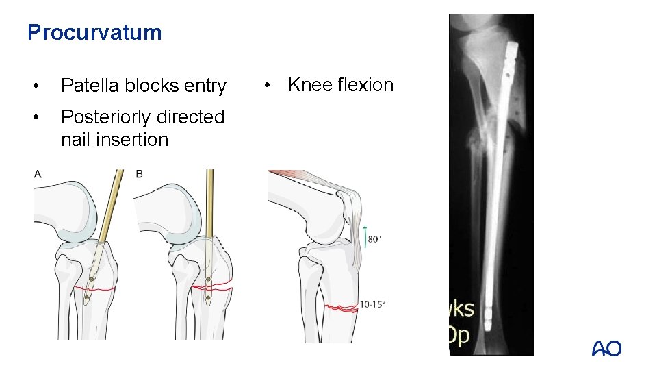 Procurvatum • Patella blocks entry • Posteriorly directed nail insertion • Knee flexion 
