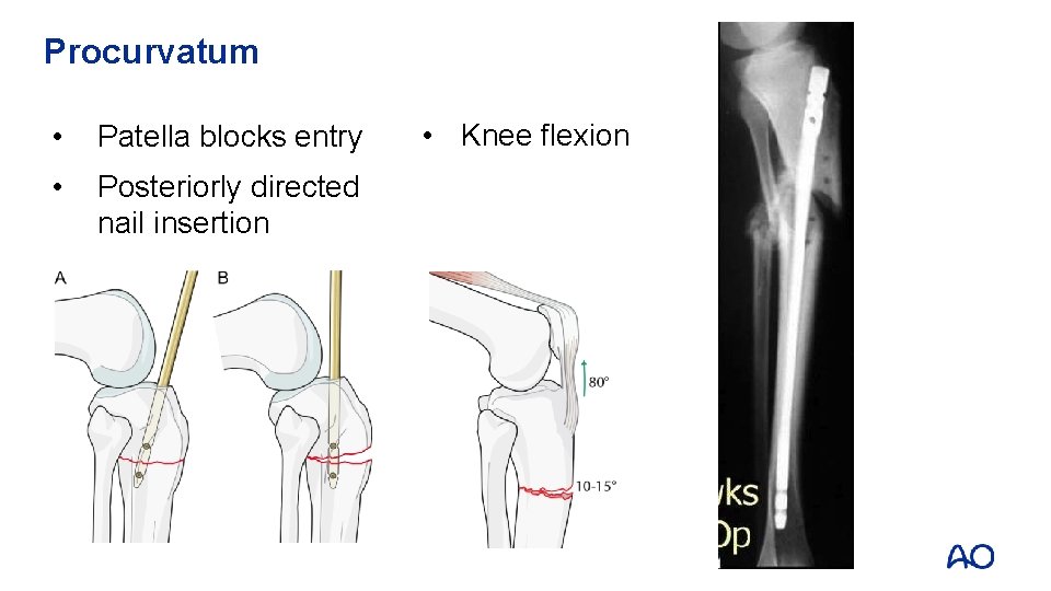Tibial Shaft Fractures AO Trauma Advanced Principles Course