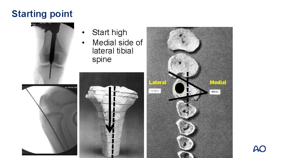 Starting point • Start high • Medial side of lateral tibial spine Lateral Medial