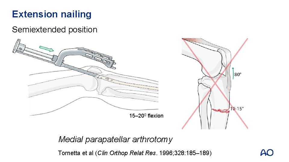 Extension nailing Semiextended position 15– 200 flexion Medial parapatellar arthrotomy Tornetta et al (Clin