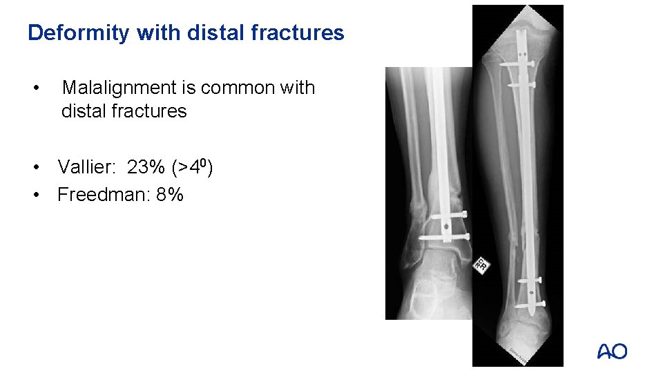 Deformity with distal fractures • Malalignment is common with distal fractures • Vallier: 23%