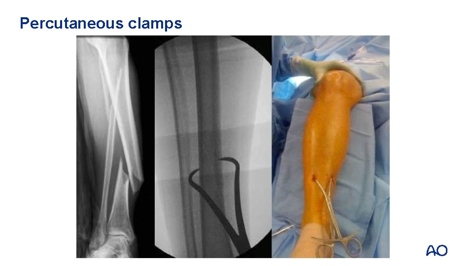 Percutaneous clamps 