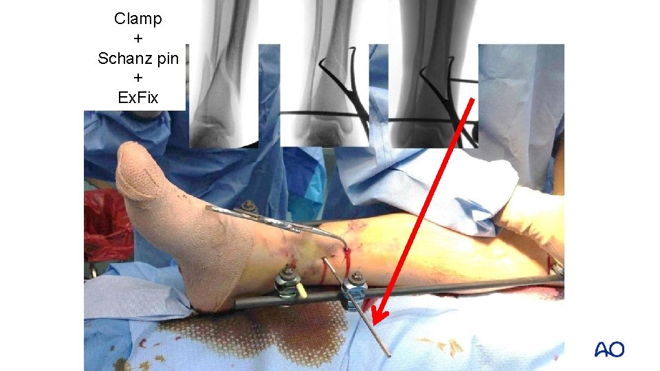 Clamp + Schanz pin Clam + Ex. Fix 