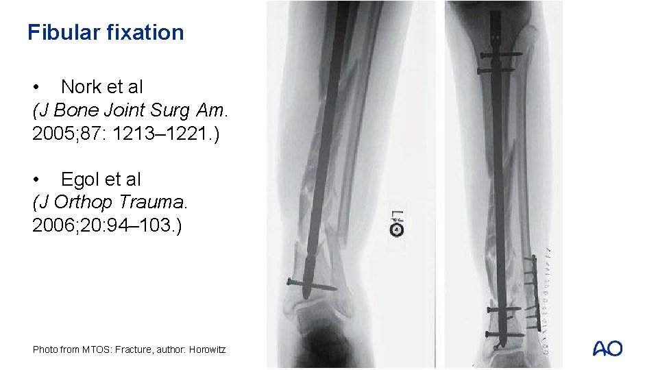 Fibular fixation • Nork et al (J Bone Joint Surg Am. 2005; 87: 1213–