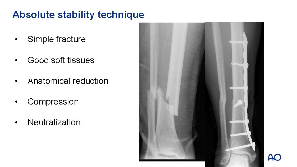 Absolute stability technique • Simple fracture • Good soft tissues • Anatomical reduction •