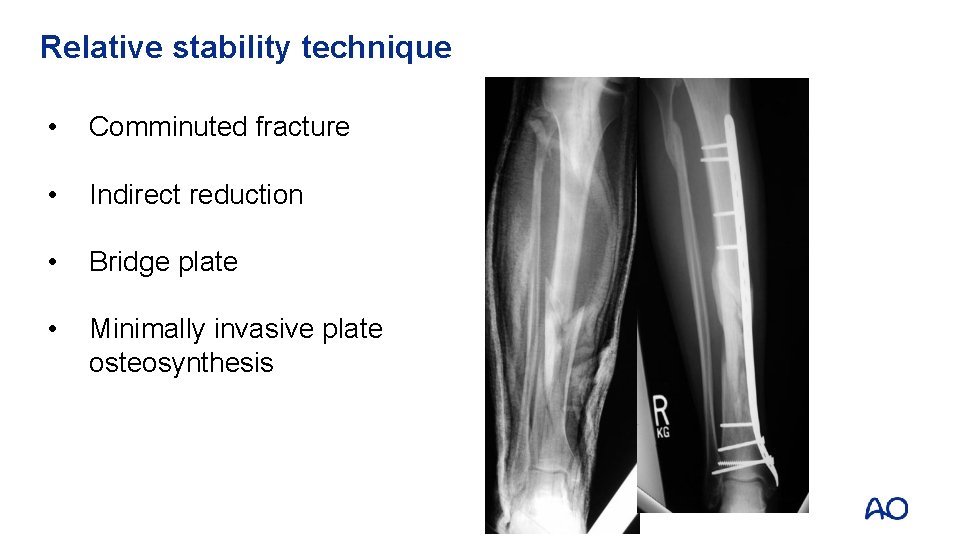 Relative stability technique • Comminuted fracture • Indirect reduction • Bridge plate • Minimally