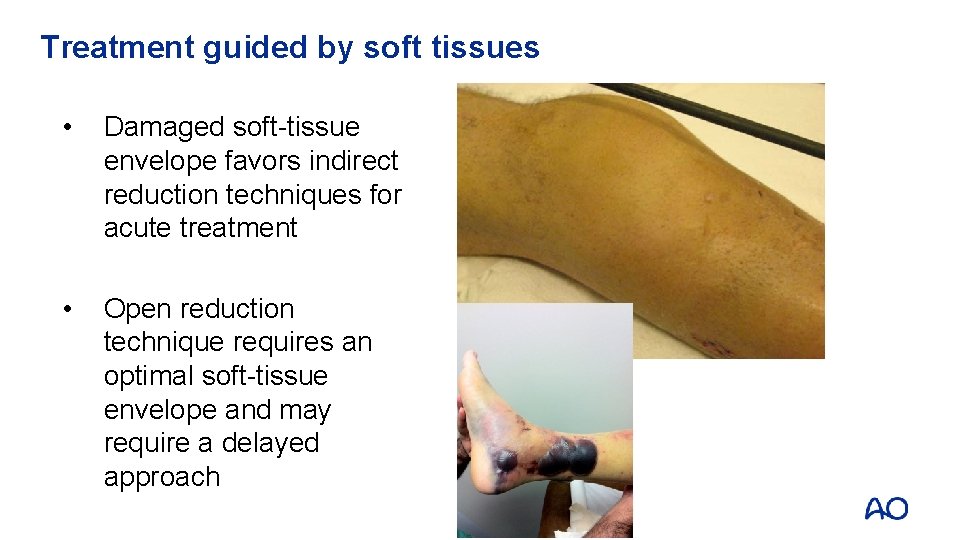 Treatment guided by soft tissues • Damaged soft-tissue envelope favors indirect reduction techniques for