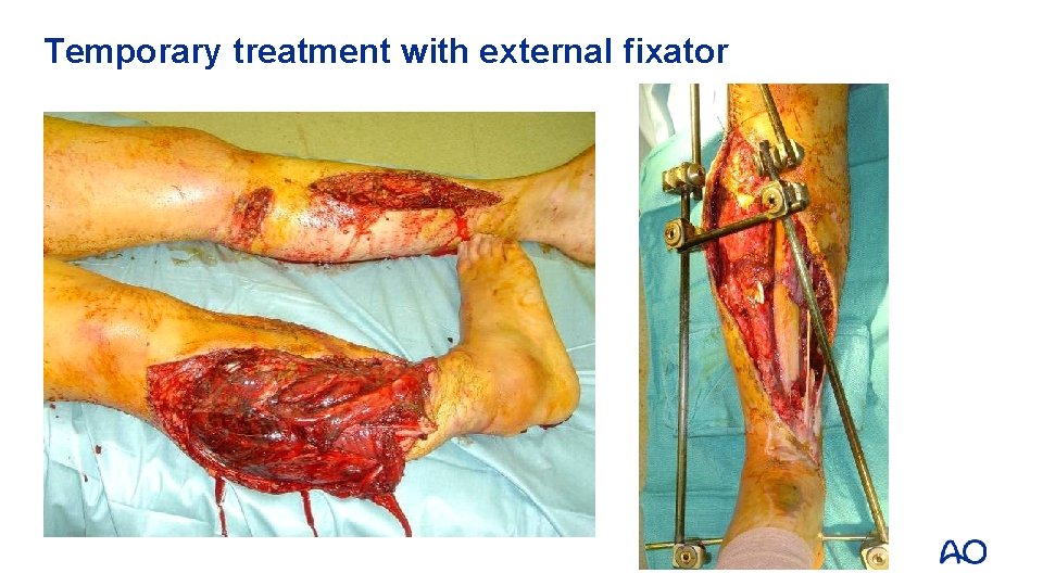 Temporary treatment with external fixator 