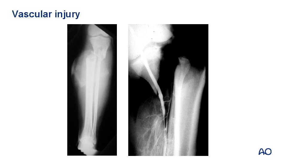 Vascular injury 