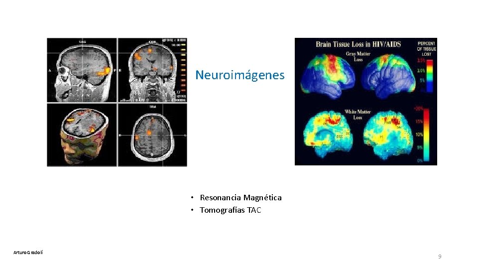  Neuroimágenes • Resonancia Magnética • Tomografías TAC Arturo Gradolí 9 
