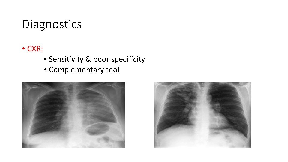 Diagnostics • CXR: • Sensitivity & poor specificity • Complementary tool 
