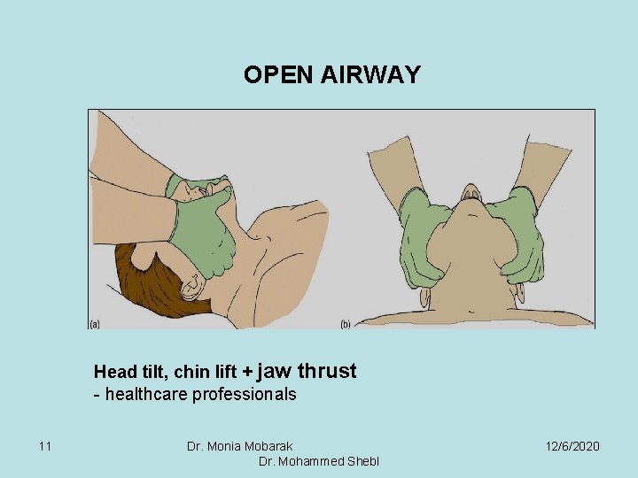 OPEN AIRWAY Head tilt, chin lift + jaw thrust - healthcare professionals 11 Dr.