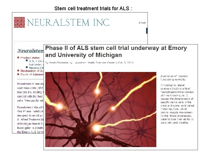 Stem cell treatment trials for ALS : 