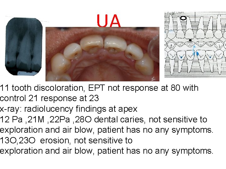 UA 11 tooth discoloration, EPT not response at 80 with control 21 response at