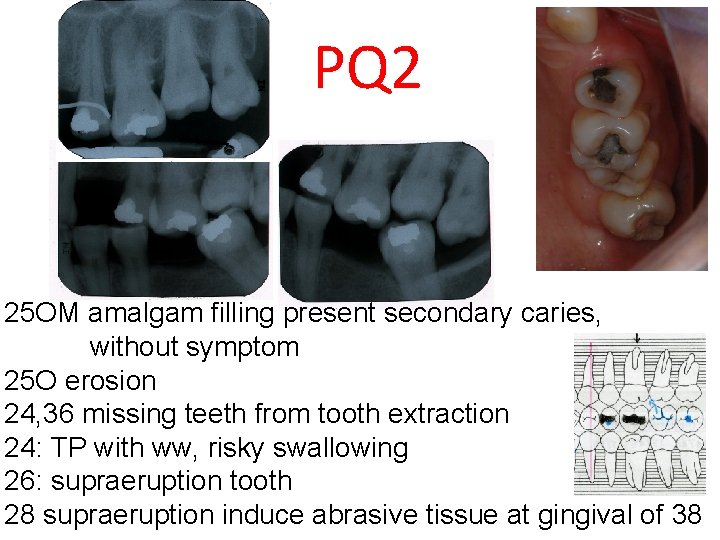 PQ 2 25 OM amalgam filling present secondary caries, without symptom 25 O erosion