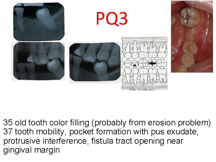 PQ 3 35 old tooth color filling (probably from erosion problem) 37 tooth mobility,