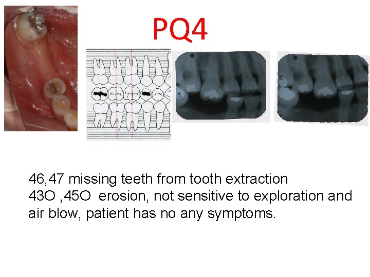 PQ 4 46, 47 missing teeth from tooth extraction 43 O , 45 O
