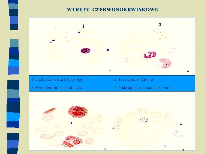 WTRĘTY CZERWONOKRWINKOWE 1 2 1. Ciałka Howella i Jolly’ego 2. Pierścienie Cabota 3. Hypochromia