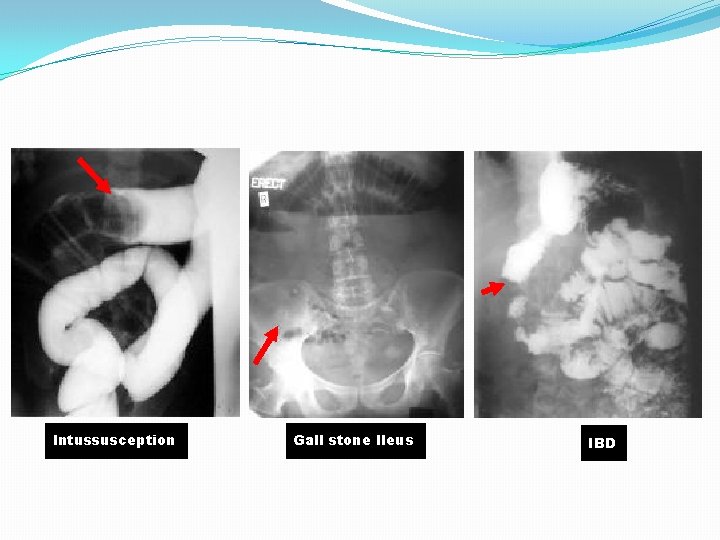 Intussusception Gall stone Ileus IBD Intussusception Gall stone Ileus IBD