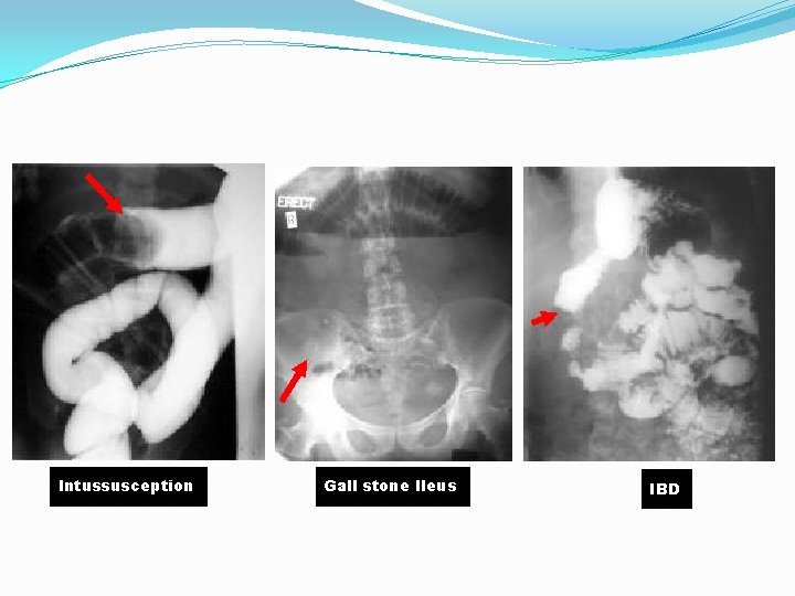 Intussusception Gall stone Ileus IBD 