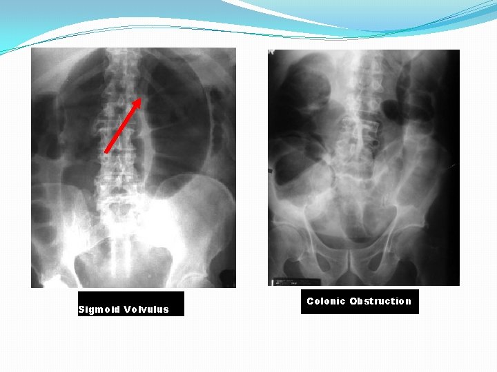 Sigmoid Volvulus Colonic Obstruction 