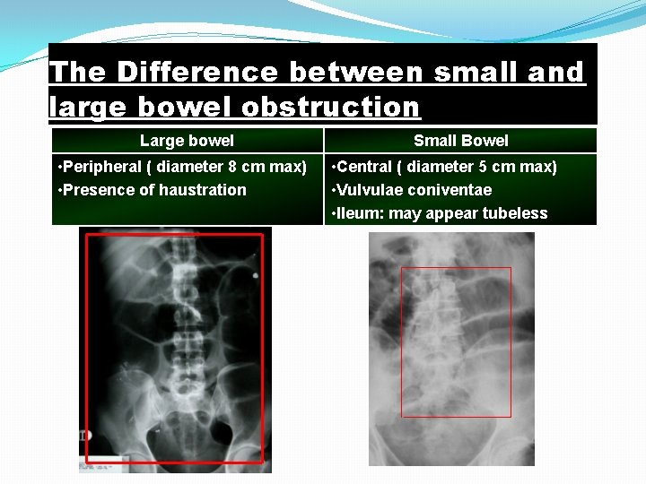 The Difference between small and large bowel obstruction Large bowel • Peripheral ( diameter