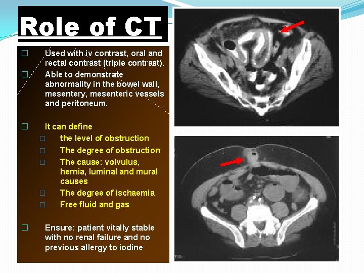 Role of CT � � Used with iv contrast, oral and rectal contrast (triple Role of CT � � Used with iv contrast, oral and rectal contrast (triple