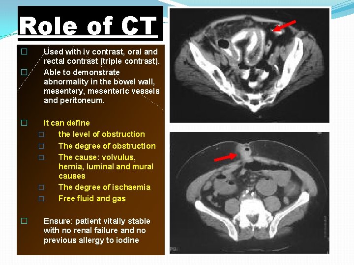 Role of CT � � Used with iv contrast, oral and rectal contrast (triple